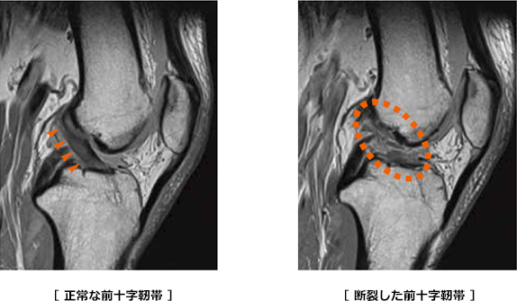 前十字靱帯損傷のMRI画像の例